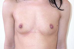 Before breast correction