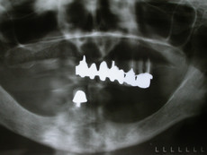 Röntgenbild vorher zeigt starken Knochenschwund im Oberkiefer und  Unterkiefer