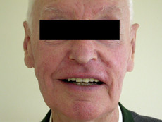 Well-fitting denture with aesthetically pleasing appearance