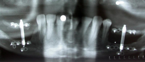 X-ray of a distraction osteogenesis (bone stretching) in the lower jaw
