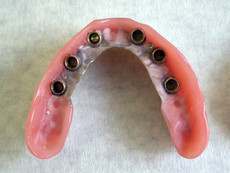 Reinforced denture base with double crowns