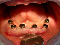 Condition after removing all teeth in the lower jaw and after implantation
