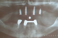 Röntgen nach Implantation im Oberkiefer