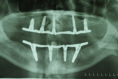Zahnimplantate mit Brückengerüsten in der Röntgenübersicht