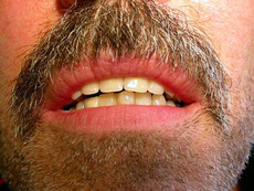 Natural looking, well-fitting denture