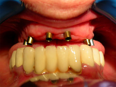 Zustand nach Setzen von 8 Zahnimplantaten (sichtbare Pfosten nach Entfernung des Provisoriums)