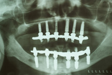 Röntgenbild nach Nervverlagerung im Unterkiefer, Entfernung aller Zähne, Sofortimplantation, Gerüstanprobe