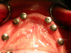 Lower jaw, after removal of temporary prosthesis and before denture fixation