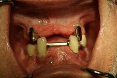 Lockere Zähne & Prothese im Oberkiefer