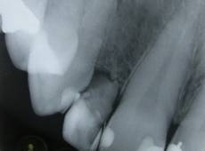 Röntgenbild bei fehlender Anlage des Zahnes 12