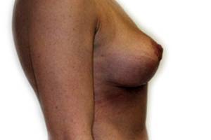 After breast correction