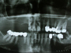 Röntgen Bild vor Sofortimplantation mit Knochenaufbau