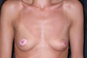 Before breast correction