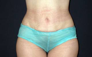 After liposuction