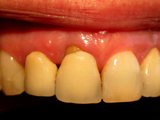 Zahnfleischrückgang bei Frontzahn