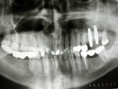 Röntgenbild von Behandlungsalternativen mit Zahnimplantaten
