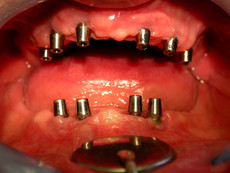 Condition after implantation in the upper jaw and lower jaw
