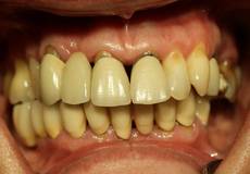 Ausgangssituation vor der Behandlung mit Zahnimplantaten im Oberkiefer