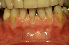 Zahnfleischrückgang bei Unterkieferzähnen
